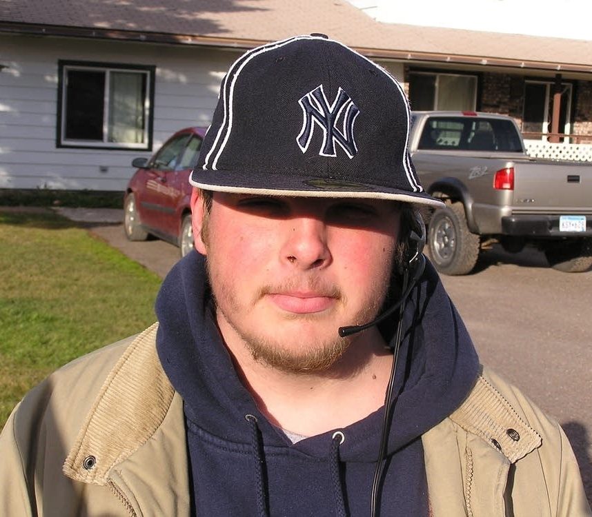 Fetal Alcohol Syndrome Face Photos in Adults