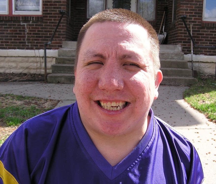 FAS Face Photos in Adults